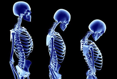 هشاشة العظام: عومل الخطر، الأعراض، وطرق الوقاية، والعلاج